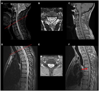 Transverse myelitis in myelin oligodendrocyte glycoprotein antibody-associated disease